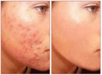 Yüzde Mantar Belirtileri ve Tedavisi Yüzde Mantar Belirtileri ve Tedavisi