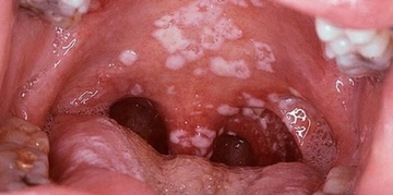 Dil Mantarı İlaçları Kullanımı ve Faydaları Nelerdir?