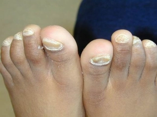 Tırnak Altı Mantarı Belirtileri ve Tedavisi Tırnak Altı Mantarı Belirtileri ve Tedavisi