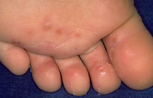 Ayak Mantarı Çeşitleri Nelerdir?