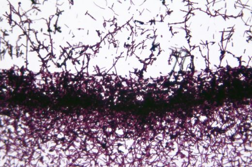 Candida Mantarı Belirtileri ve Tedavisi