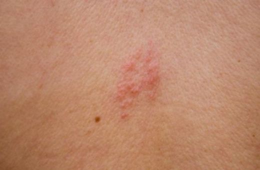 Cilt Mantarı Bitkisel Tedavisi