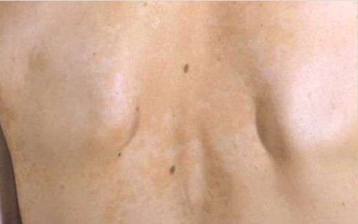 Cilt Mantarı Çeşitleri Nelerdir?