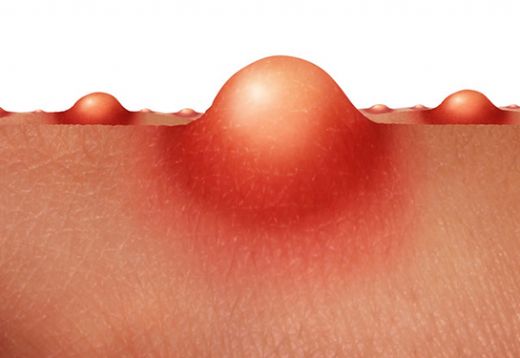 Genital Bölgede Mantar Belirtileri ve Tedavisi