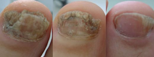 İbrahim Saraçoğlu Tırnak Mantarı Belirtileri ve Tedavisi
