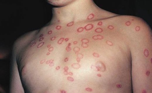 Maya Mantarı Hastalığı Belirtileri ve Tedavisi