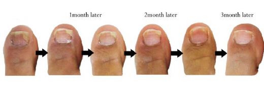 Yaş Maya Ayak Mantarı Belirtileri ve Tedavisi